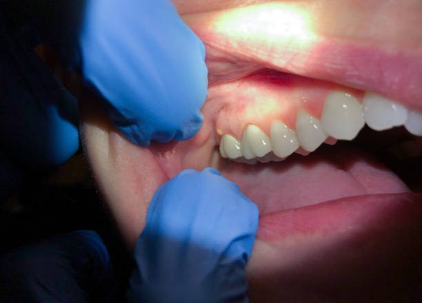 Best Emergency Tooth Extraction in Mcminnville, TN