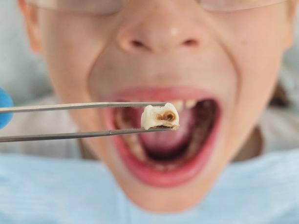 Best Emergency Root Canal Treatment in Mcminnville, TN